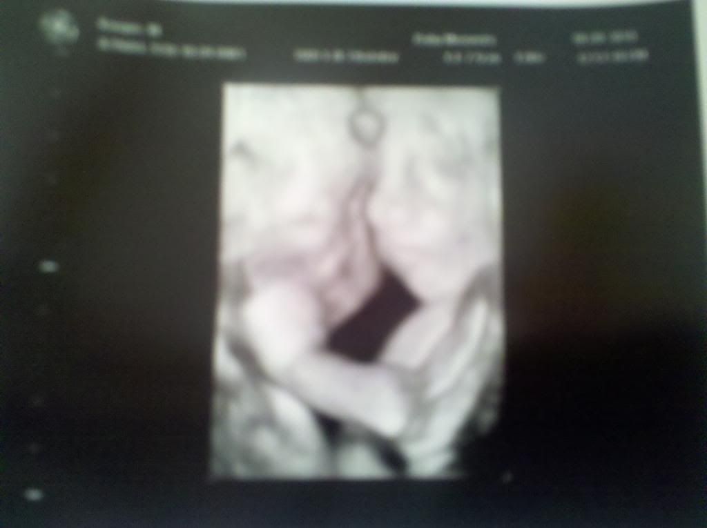 3d ultrasound pictures at 20 weeks. 3D-Ultrasound-St.-Louis