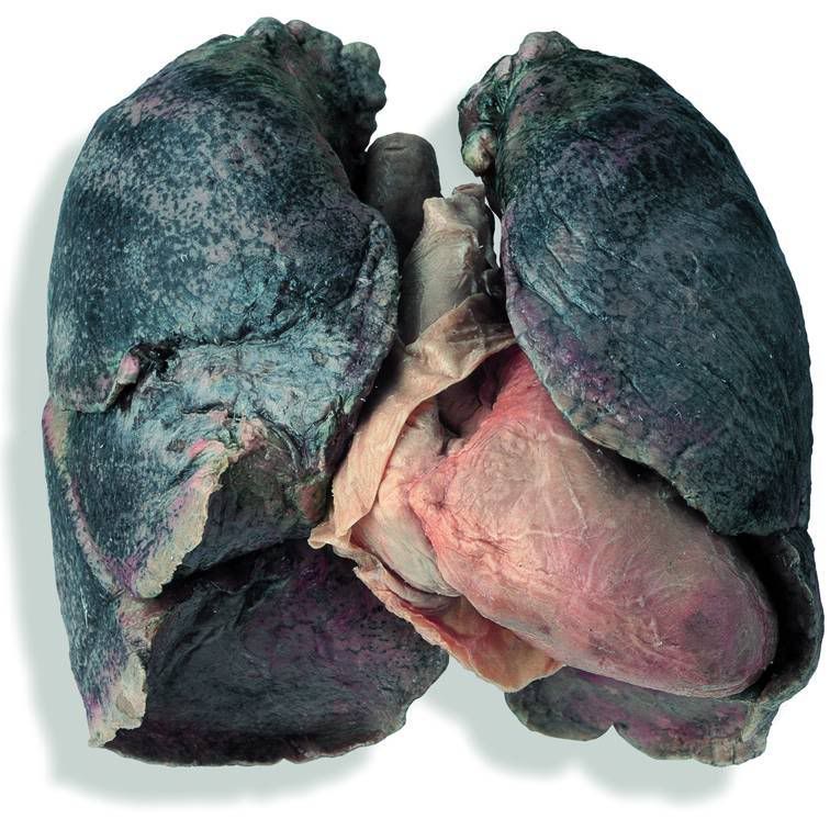 A smoker's lung.
